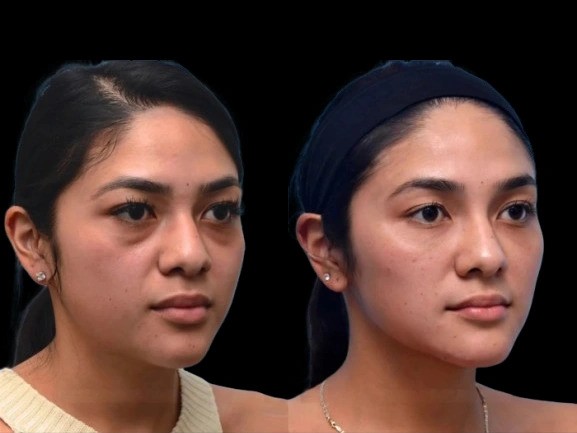 How Best Doctors in Dubai Customize Dark Circles Treatment for Every Skin Type