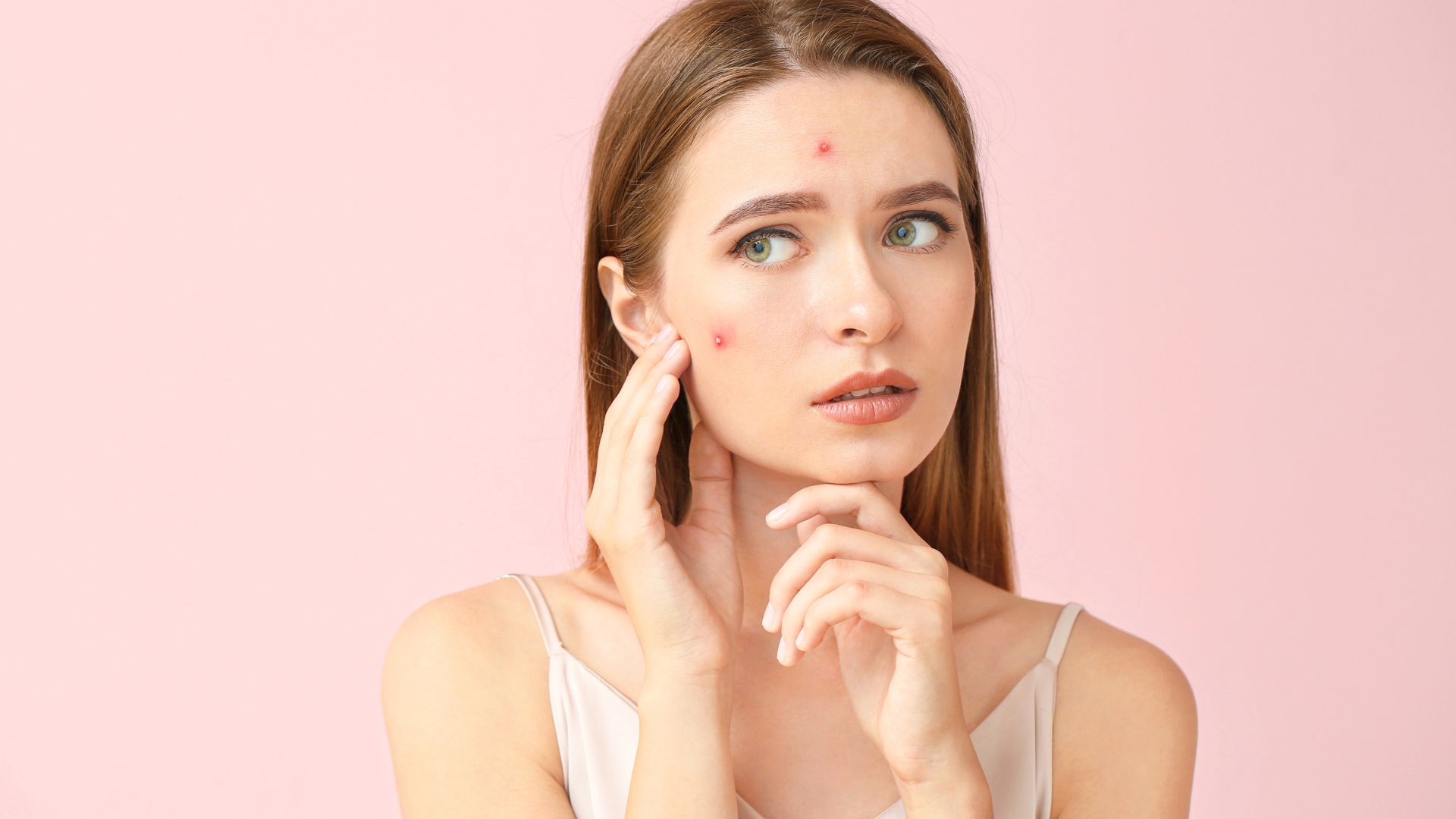 Acne Treatment in Dubai: How to Prevent Future Breakouts Naturally