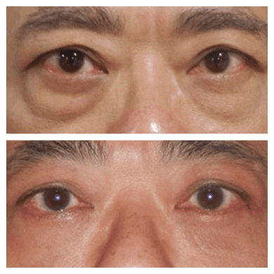 Eye Bag Removal in Dubai: Laser Resurfacing for Eye Bags