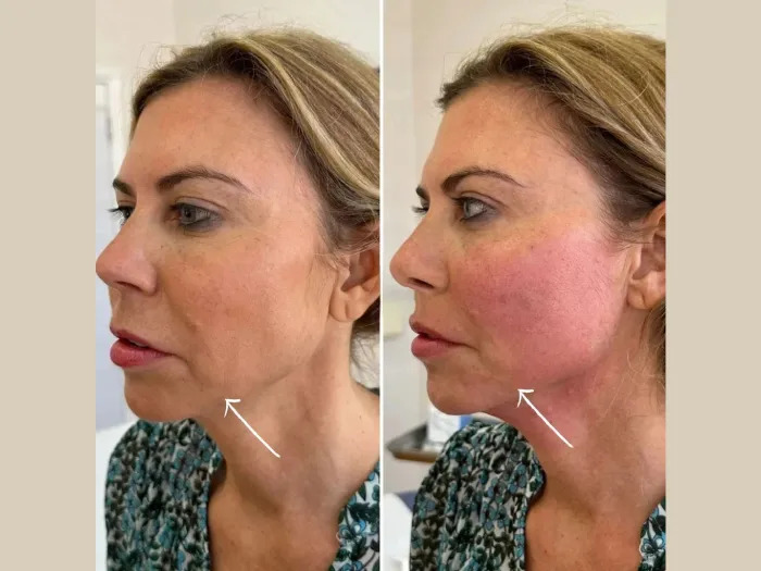 Endolift vs Traditional Skin Tightening at the Best Aesthetic Clinics in dubai