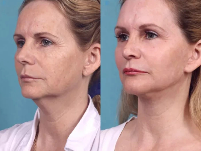 Best Doctors in dubai for Chemical Peels Recommended by Dermatology Experts