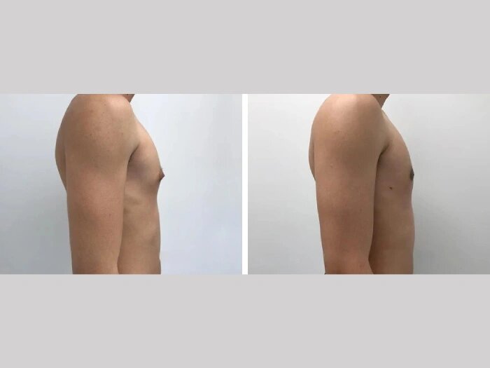 A Guide to the Best Gynecomastia Surgeons in dubai