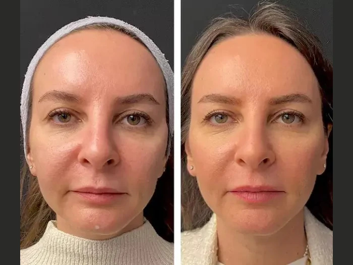 Mesotherapy Treatment in Dubai: Professional Care Explained