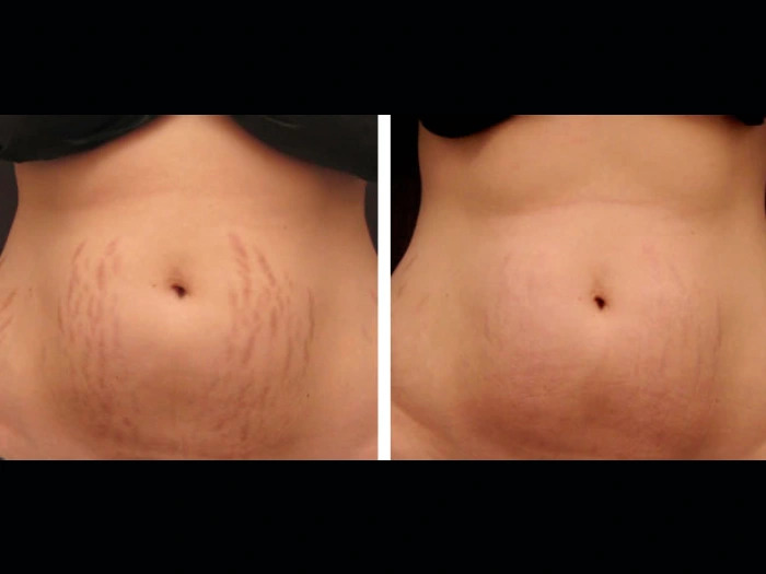 Elevate Your Glow Through Radiofrequency (RF) Microneedling Treatments in Dubai