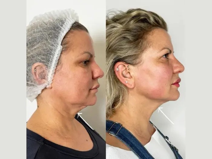 Why Best Doctors in Dubai Recommend Endolift for Non-Surgical Face Lifting