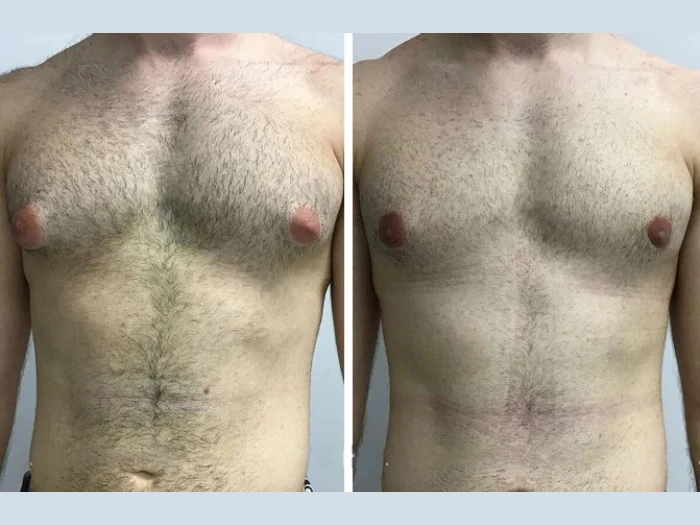 Long-Term Gynecomastia Results Achieved with Best Doctors in Dubai