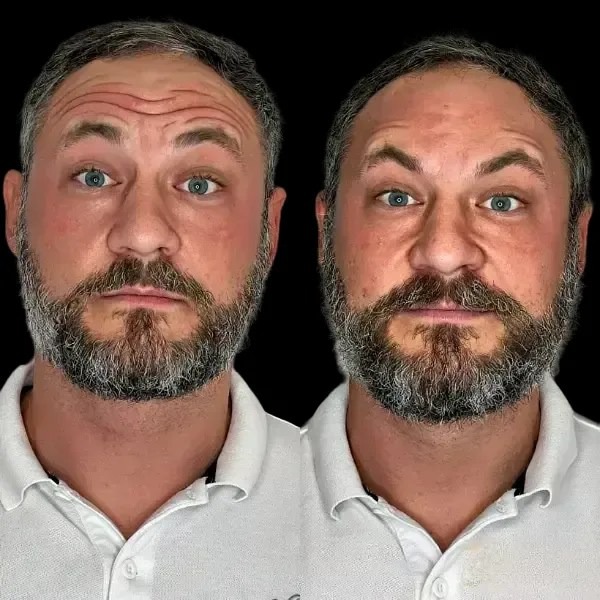 Skin Upgrade Starts with Profhilo at the Best Aesthetic Clinic in dubai