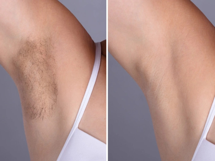 Best Doctors in Dubai Known for Safe Laser Hair Removal Procedures