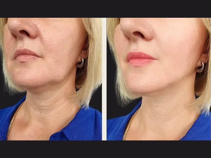 PRP Treatment in Dubai Face Glow