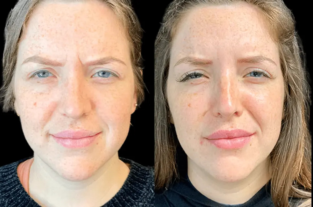 Botox Treatments in Dubai: What to Expect Before and After the Procedure