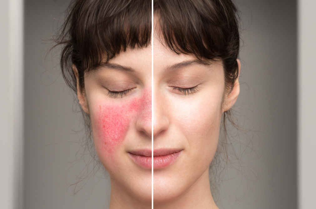 Natural Rosacea Remedies in Manchester