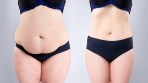 Combining Liposuction with Abdominoplasty Dubai: Is It Safe?