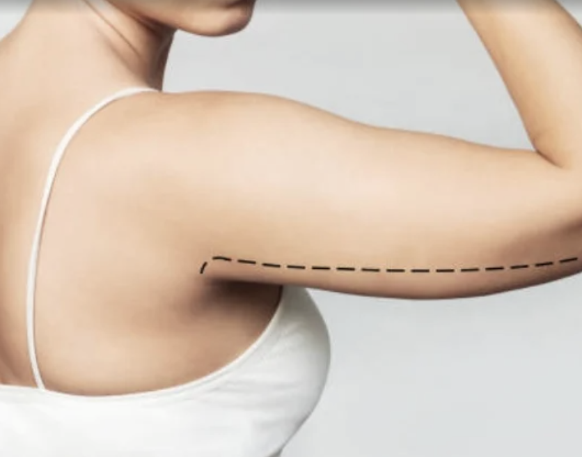 Arm Lift in Dubai – Your Complete Treatment Overview