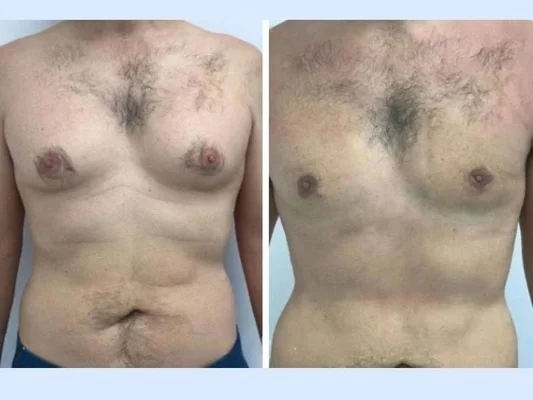 Why Celebrities Trust the Best Gynecomastia Surgeon in Dubai for Confidential Procedures