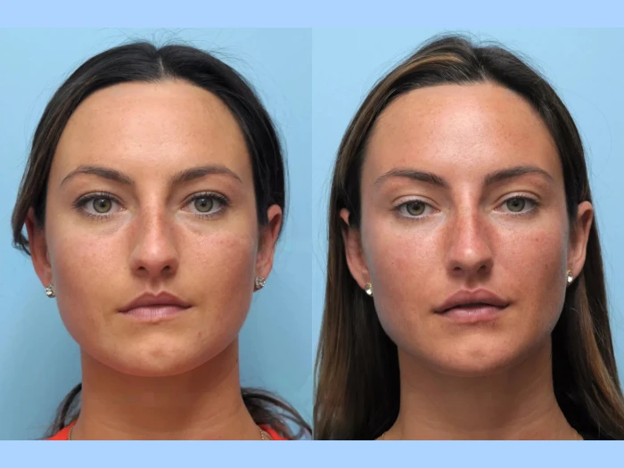 Achieve a Youthful Look with Expert Thread Lift Procedures by the Best Doctors in Dubai
