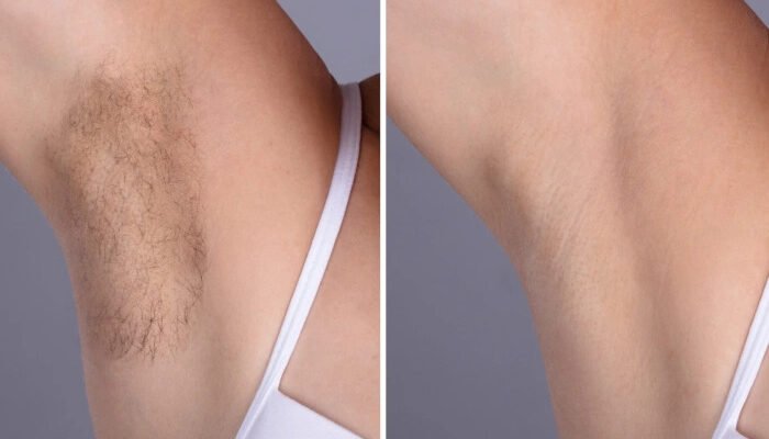 Best Doctors in Dubai for Safe & Advanced Laser Hair Removal