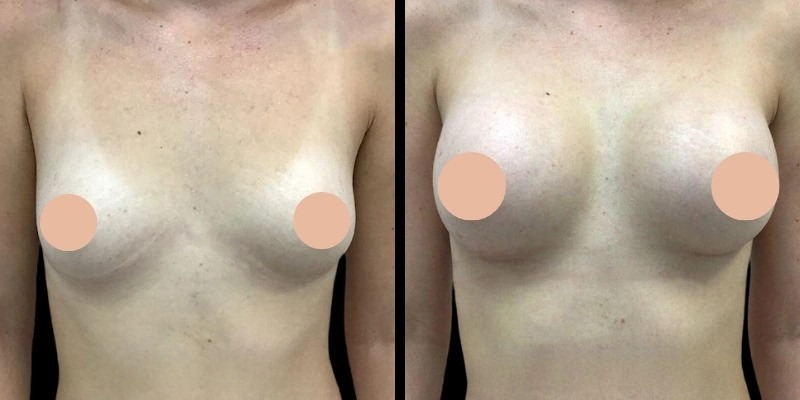Breast Augmentation Recovery Timeline Explained by the Best Breast Augmentation Surgeon in Dubai
