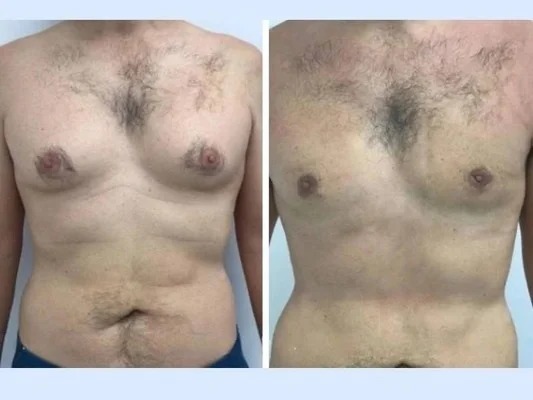 Best Gynecomastia Surgeons in dubai Explained by the Best Specialists
